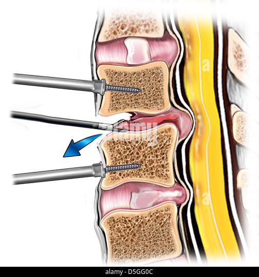 Spine Bone Fusion With Fibular Allograft Stock Photo, Royalty Free ...